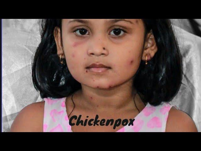 What You Need to Know About Chickenpox: Symptoms, Stages, and Prevention