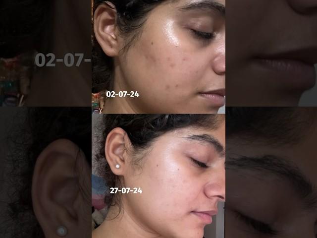 7 things I strictly follow to maintain my ACNE PRONE SKIN #skincare #clinicalcosmetologist