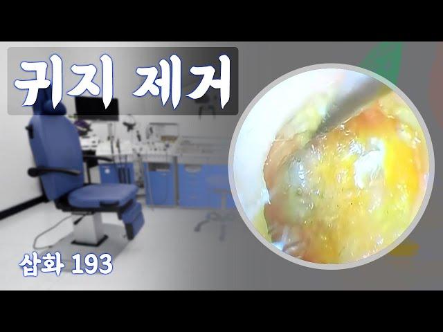 Ep 193 - 로지 드 이어 왁스 제거 - 귀지 제거