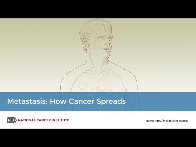 Metastasis: How Cancer Spreads