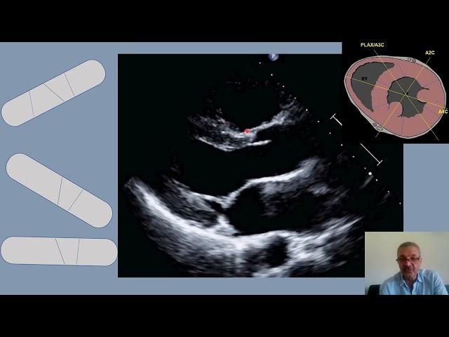 Live: Tips & mistakes in PLAX measurements