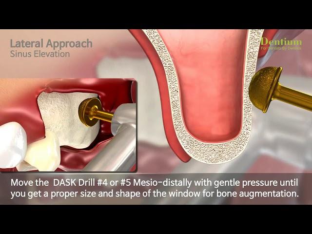 DASK - Total Solution for Sinus Lateral approach