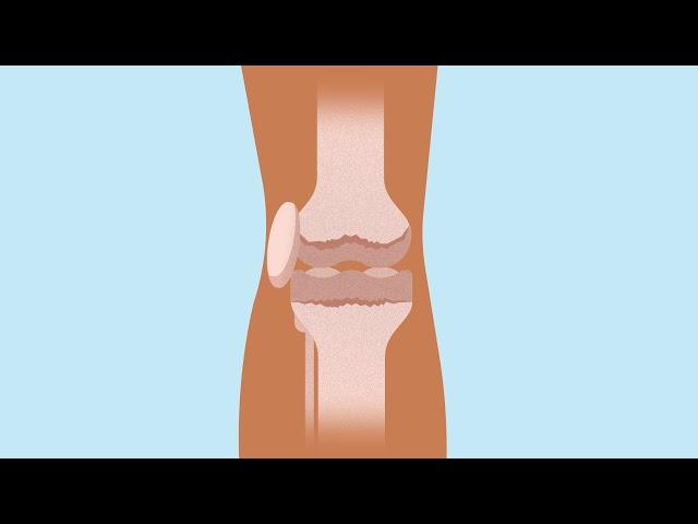 How knee replacement surgery is carried out | Bupa Health