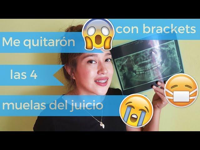 ME QUITARON LAS MUELAS DEL JUICIO / CORDALES  (Dia 1,2 y 4 ) Mi experiencia | COSTEÑITOS COATZA