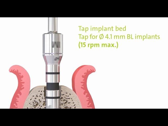 Straumann® PURE Ceramic Implant Monotype: Step by Step.