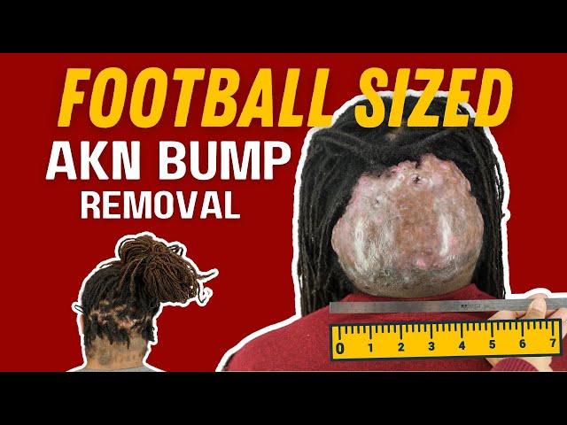 REMOVING a FOOTBALL SIZED Acne Keloidalis Nuchae (AKN) Bump!