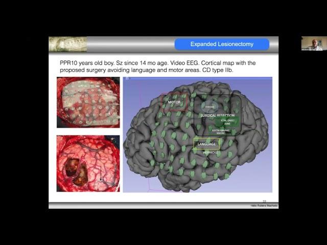 Epilepsy Surgery in Children - Prof Helio Rubens Machado