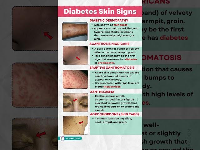 Diabetes Warning Signs: 5 Skin Changes That Could Save Your Life  #diabetes #ytshorts #nutrition