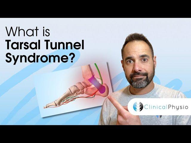 Tarsal Tunnel Syndrome | Expert Physio Guide