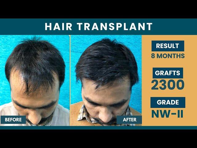 Hair Transplant in Delhi | Best Results | Hair Transplant Cost in Delhi | SkinQure