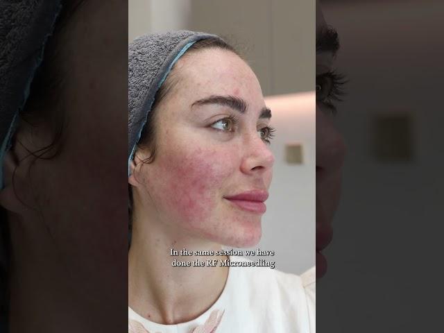 Acne Scars & Pigmentation Treatment