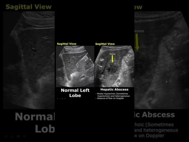 Hepatic Abscess On Ultrasound | Liver Normal Vs Abnormal USG | Abdominal Sonography #shorts