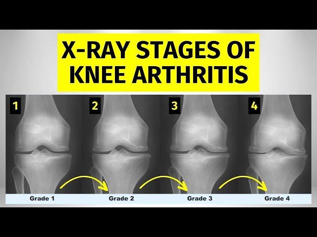 Knee Arthritis X-ray Stages: What You Need To Know