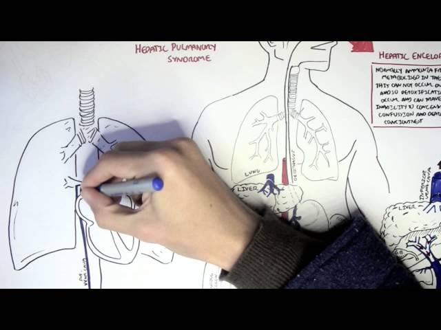 Liver Cirrhosis