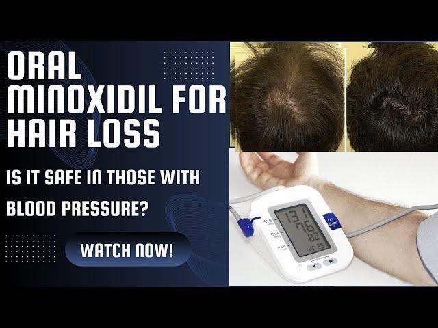 Minoxidil for hair loss | can we use in those with blood pressure?