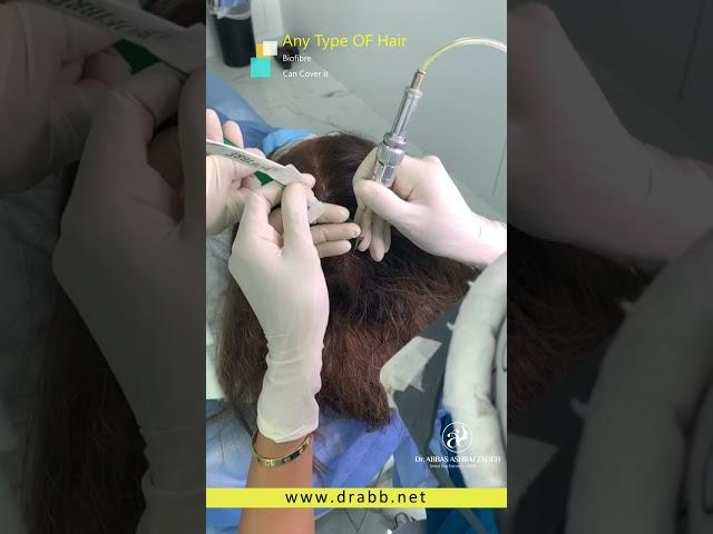 Biofibre hair implant in Dubai By Dr.abbas Ashrafzadeh ( biofiber hair implant)