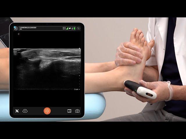 Ultrasound of the Lateral Ankle Ligaments