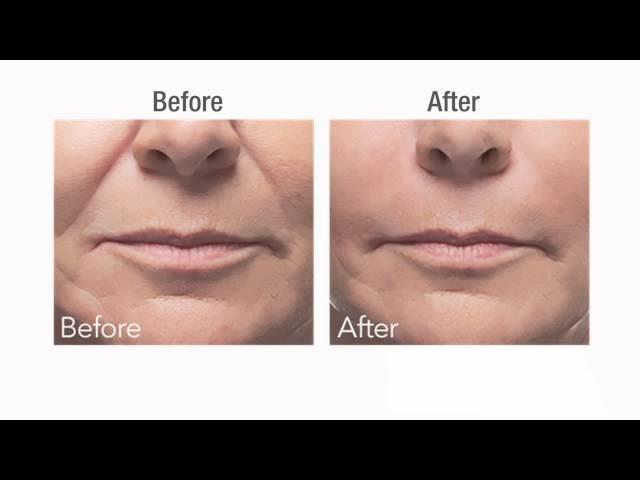 Botox vs Dermal Fillers