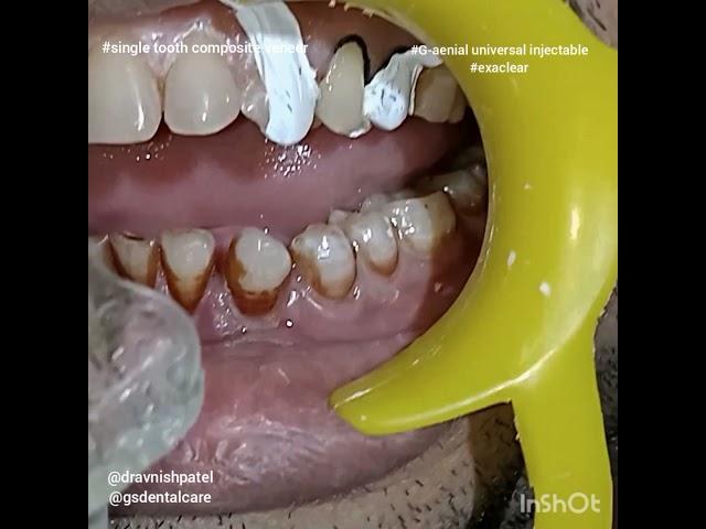 Composite Veneer  | GC India | GC G-aenial Universal Injecatable technique | Exaclear | Dr Avnish