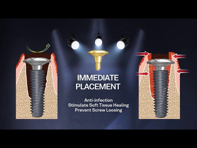 We launched New Implant Screw "BIOARK"