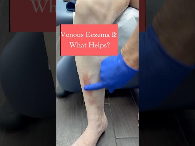 Venous Eczema & What Helps? #varicoseveins #eczema #dermaka #itchyskin #dryskin #venousdisease