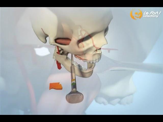 lefort 1 osteotomy orthognathic