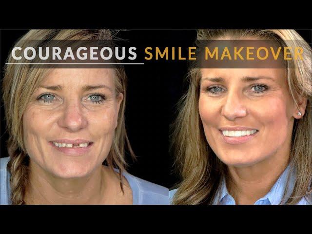 Broken Teeth to Brave Smile - Dental Veneer Makeover by Brighter Image Lab - NO Cosmetic Dentist