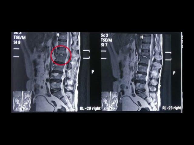 Patient Success Story | Spine Surgery | Dr Sahil Batra | Best Spine Surgeon In Punjab