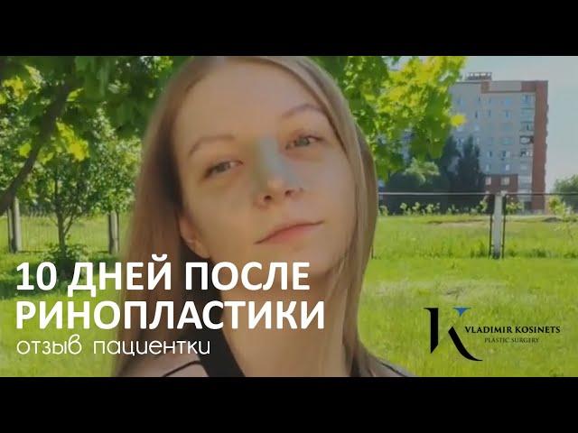 10 дней после ринопластики - хирург Владимир Косинец