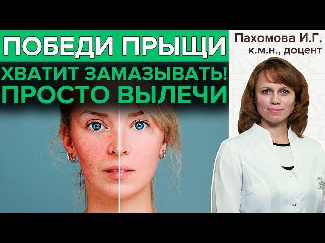 КАК ИЗБАВИТЬСЯ ОТ ПРЫЩЕЙ | Надёжный способ вылечить акне