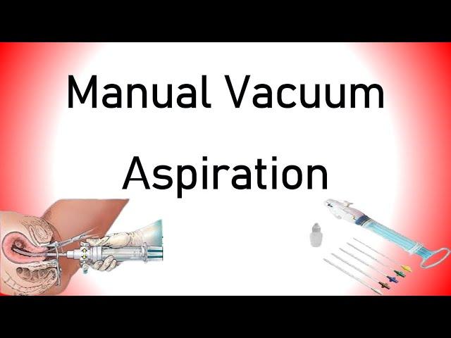 Manual Vacuum Aspiration (MVA)