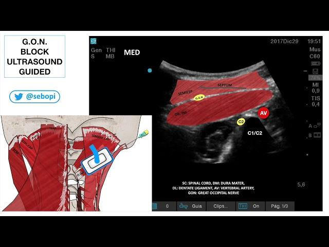 G.O.N. BLOCK ULTRASOUND GUIDED
