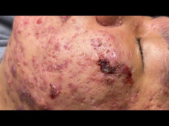 Blackheads & Pimples Pore Removal New 2024[FULL] | Acne Treatment With  Bo Nguyễn Spa