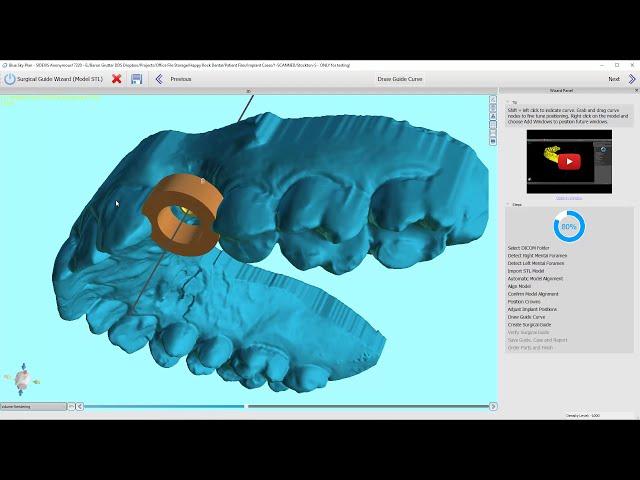 BlueSkyPlan v4.8.2.3 - Surgical Guide: Wizard Workflow