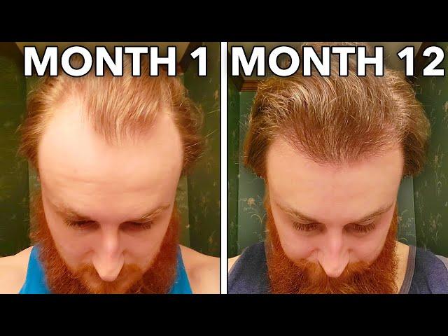 How To Reverse Hair Loss In 12 Months