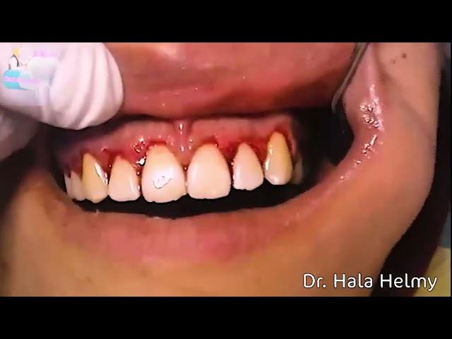 Episode 8 ...Gingivectomy & Lip repositioning {LIVEDEMO} || Dental Capsules