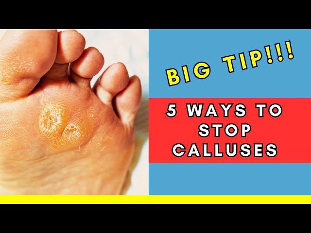 STOP Calluses: 5 Steps to Prevent Them from Returning (Podiatrist Tips!) | BONUS clinic strategy