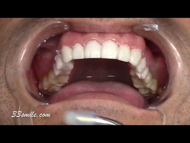 Prepless porcelain dental veneers cosmetic dentistry - San Antonio, TX