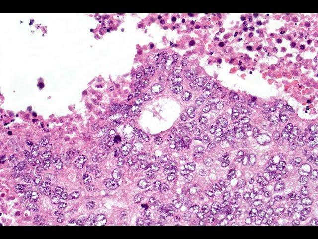 Clear cell hidradenocarcinoma McKee