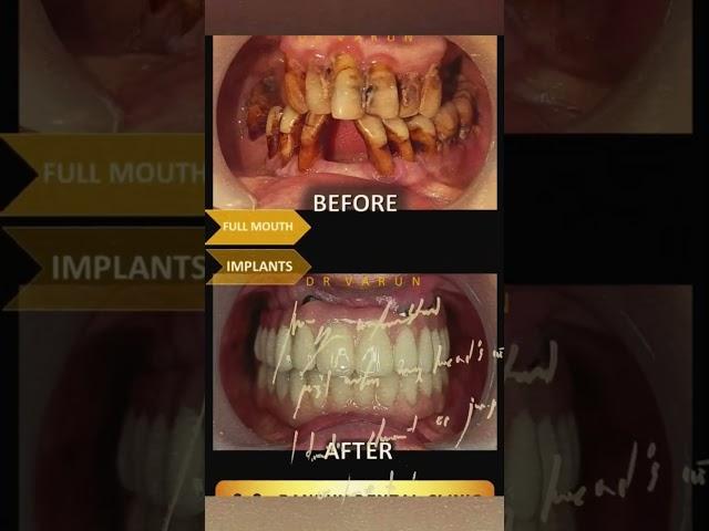 No Teeth -Dental Implants to ur Rescue #dentalimplants #delhidentist