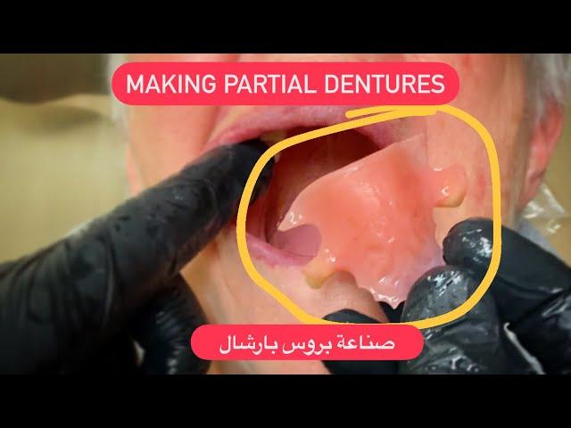 MAKING PARTIAL DENTURE WITHOUT CLASPS . صناعة بارشال ٣ اسنان #WAXBAE