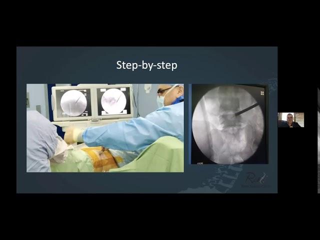 Transforaminal Endoscopic Lumbar Discectomy (TELD)