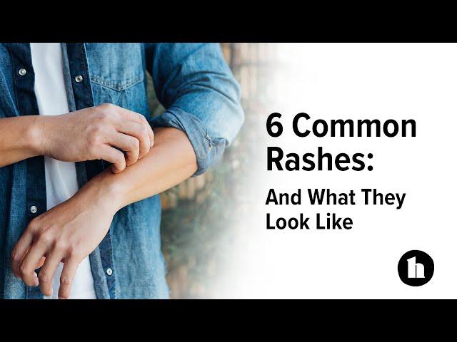 6 Common Rashes: And What They Look Like | Healthline