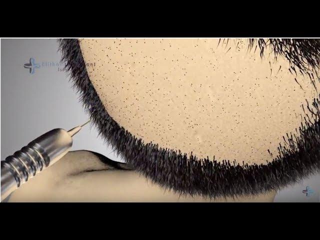 ►  FUE Haartransplantation und Perkutan – dies sind die  Vorteile bei Elithairtransplant ◄