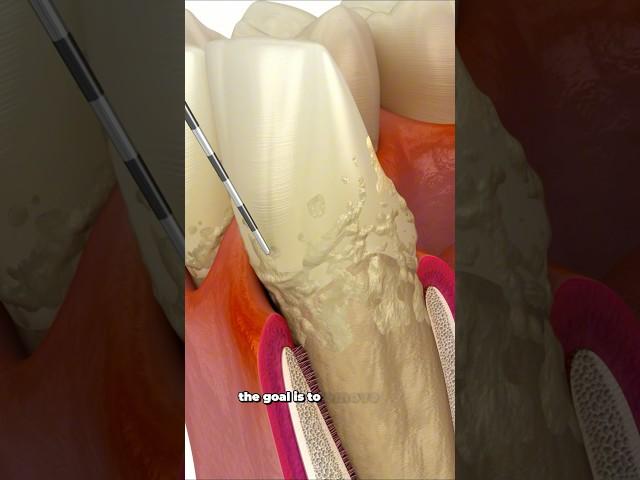 Reverse Periodontal Disease Before Losing Teeth?