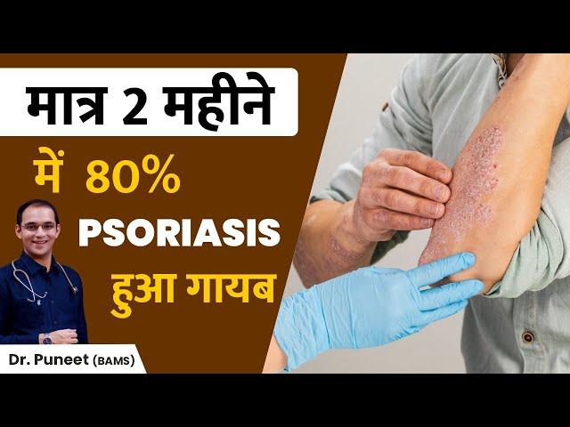 Skin Psoriasis Patient Testimonial | karma ayurveda | dr puneet dhawan