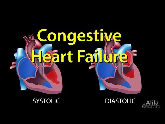 Congestive Heart Failure: Left-sided vs Right-sided, Systolic vs Diastolic, Animation.