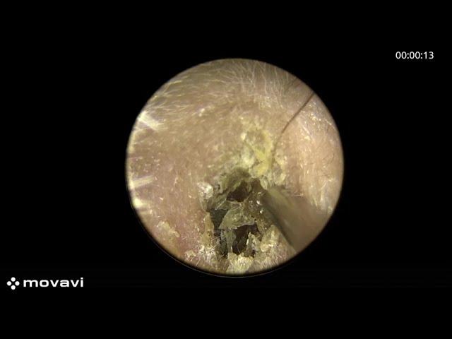 Removing earwax stuck in the ear canal | ENT | Earwax removal | Ear cleaning | Cerumen impaction