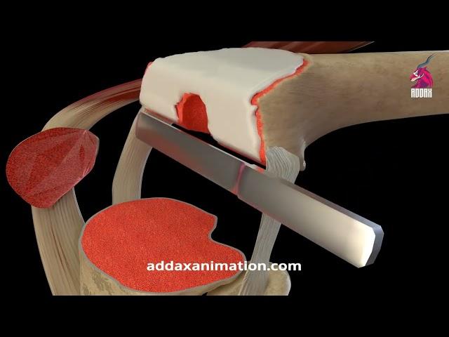 Knee Replacement Surgery 3D animation