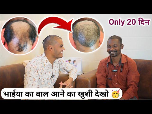 Hair Transplant In Raipur Chhattisgarh | Raipur CG Best FUE Hair Transplant Results Before And After